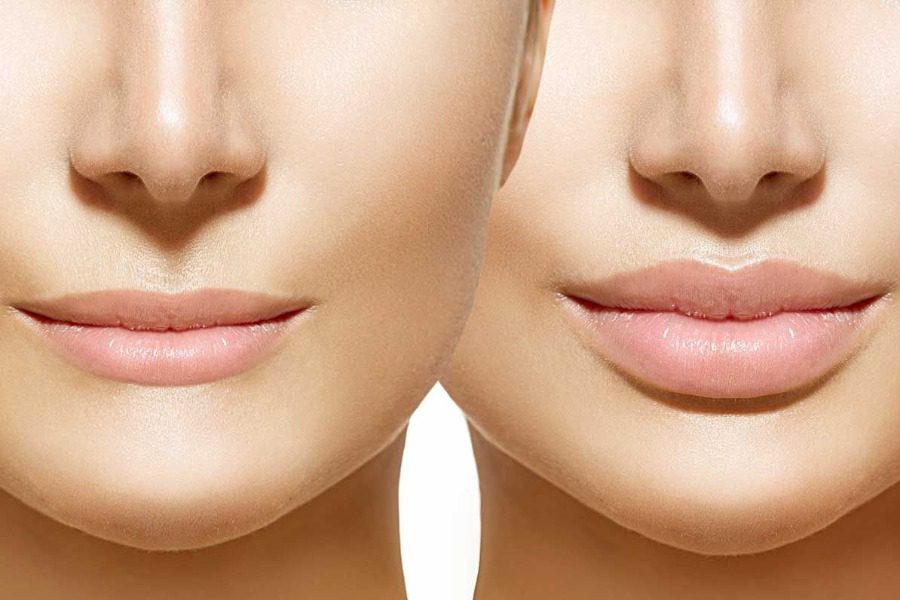 بهترین دکتر تزریق ژل لب در دزفول