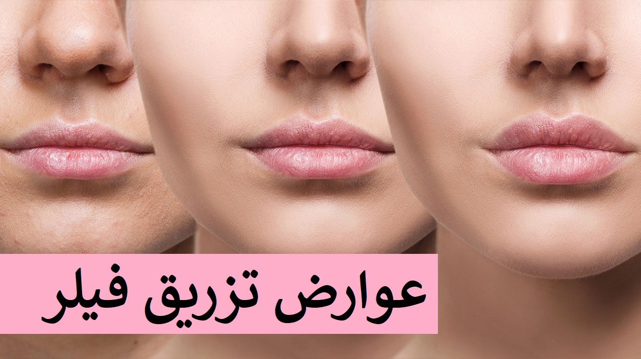 عوارض شایع و موقت فیلر صورت