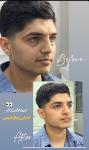 تصاویر نمونه انجام فیلر زیر چشم توسط دکتر مریدنژاد