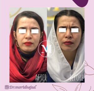 نمونه تزریق بوتاکس پیشانی توسط دکتر مریدنژاد
