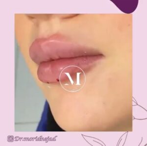 نمونه فیلر لب توسط دکتر مریدنژاد