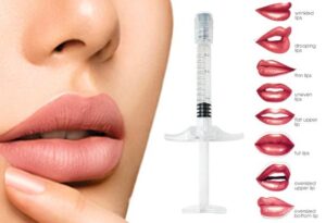 انواع فرم لب برای تزریق ژل