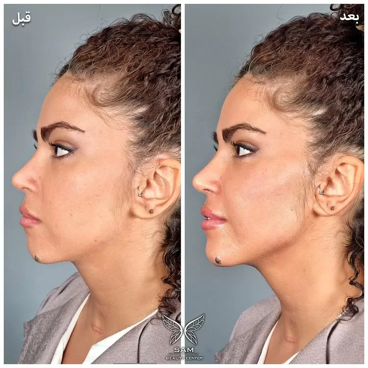 زاویه سازی صورت