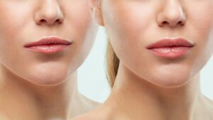 فیلر یا ژل؟ کدام بهتر است؟
