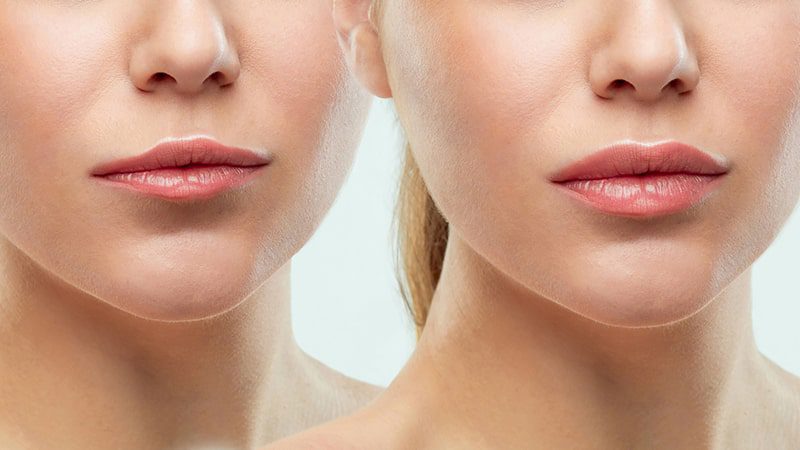 فیلر یا ژل؟ کدام بهتر است؟