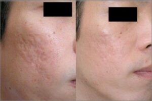 سابسیژن جای جوش
