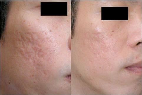 سابسیژن جای جوش